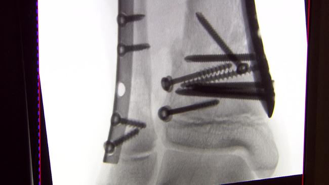 Röntgenbild mit Schrauben und Platten
