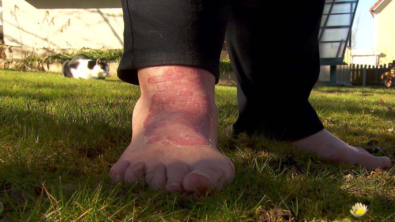 Das Bild zeigt den Vorfuß mit der Psorias Stelle