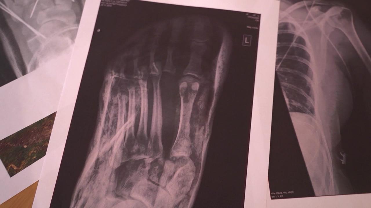 © ORF / : Gabi Hanke Das Bild zeigt die Röntgenbilder des Unfallopfers