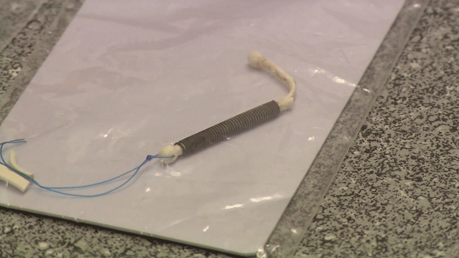 Defekte Verhütungsspirale, an der die rechte obere Hälfte abgebrochen ist.