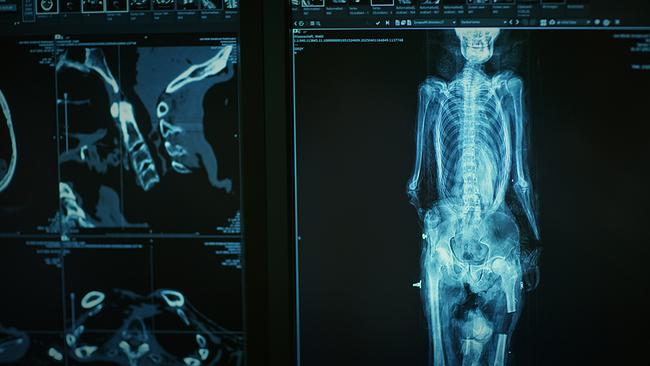 © ORF/METAFILM CT-Scan von Duncan MacPhersons Leichnam.