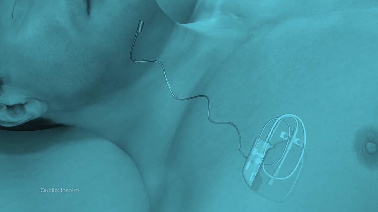 © inspire 3D-Simulation eines Zungenschrittmachers und seine Anwednung an einem Menschen