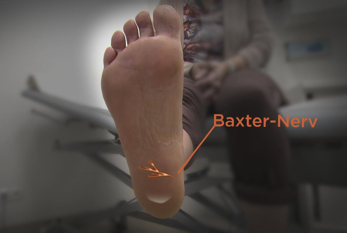 © ORF Fusssohle mit eingezeichneten Baxter-Nerv