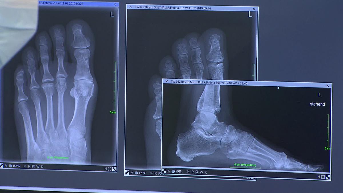 Röntgenbilder von Füßen die Hallux zeigen