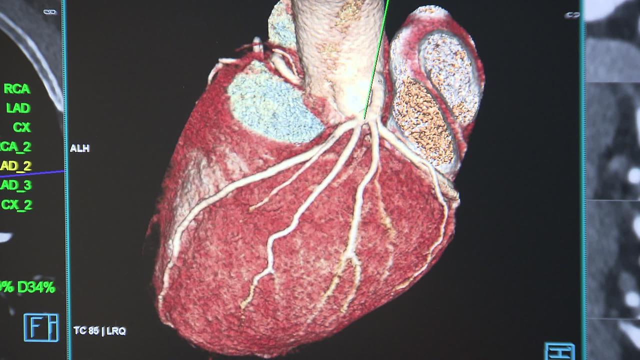 Herz CT Bild