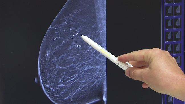 Bildgebung Mammographie, Querschnitt einer Brust