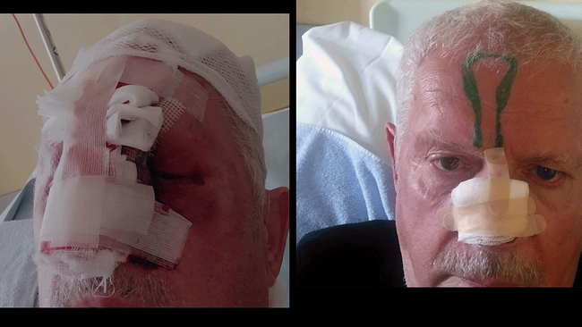 Gegenüberstellung von Mann nach OP an Nase mit verbundenen Wunden.