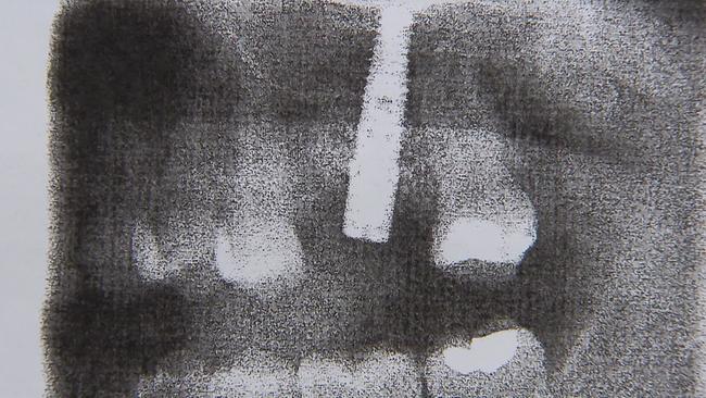 Zu sehen ist ein Röntgenbild von Frau N., auf dem man in einer Zahnlücke einen großen Teil eines Implantates sieht, das tief ins Oberkiefer geht.